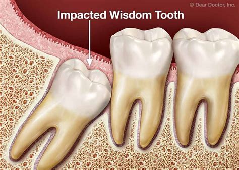 Wisdom Teeth Extractions .